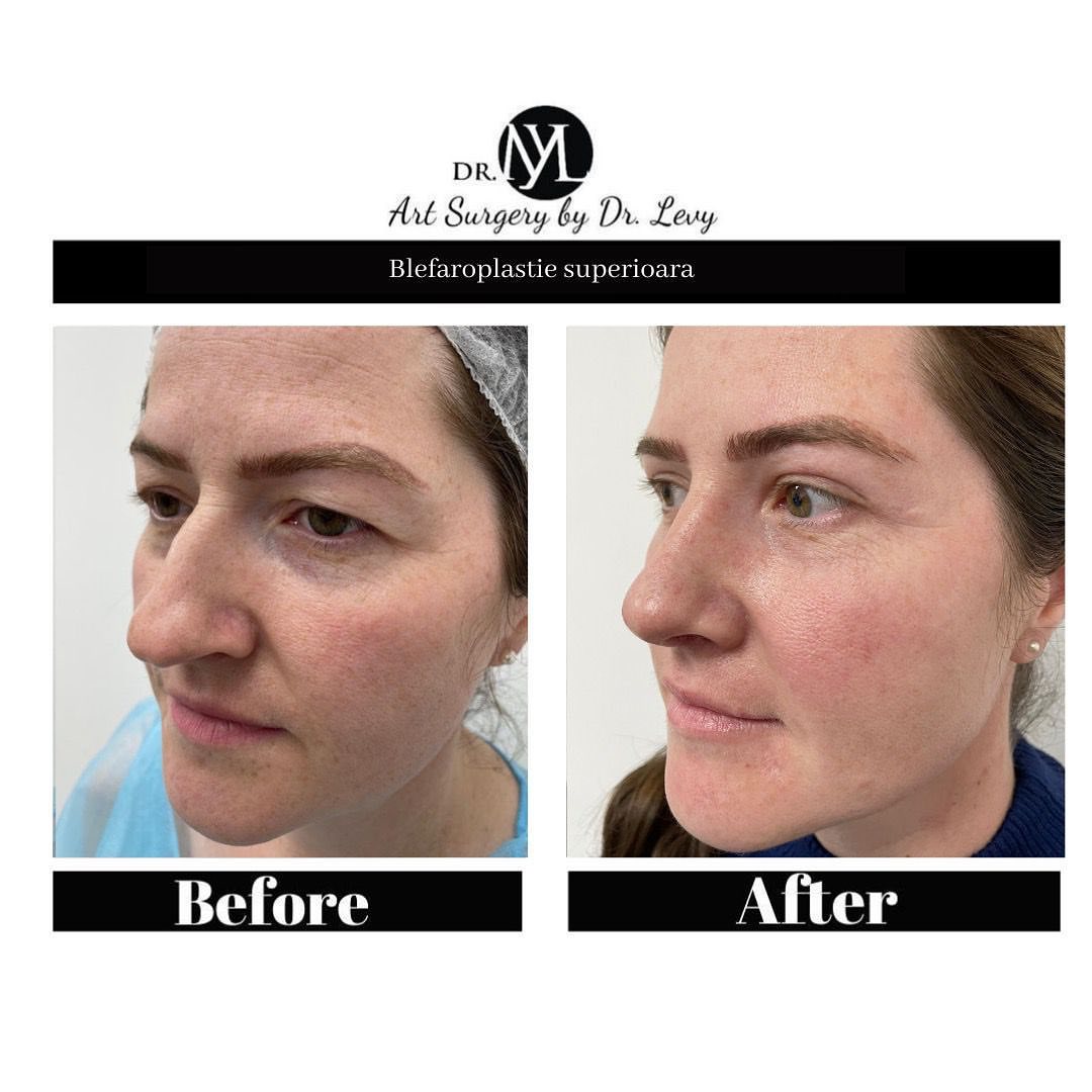 poze operatie blefaroplastie superioara
