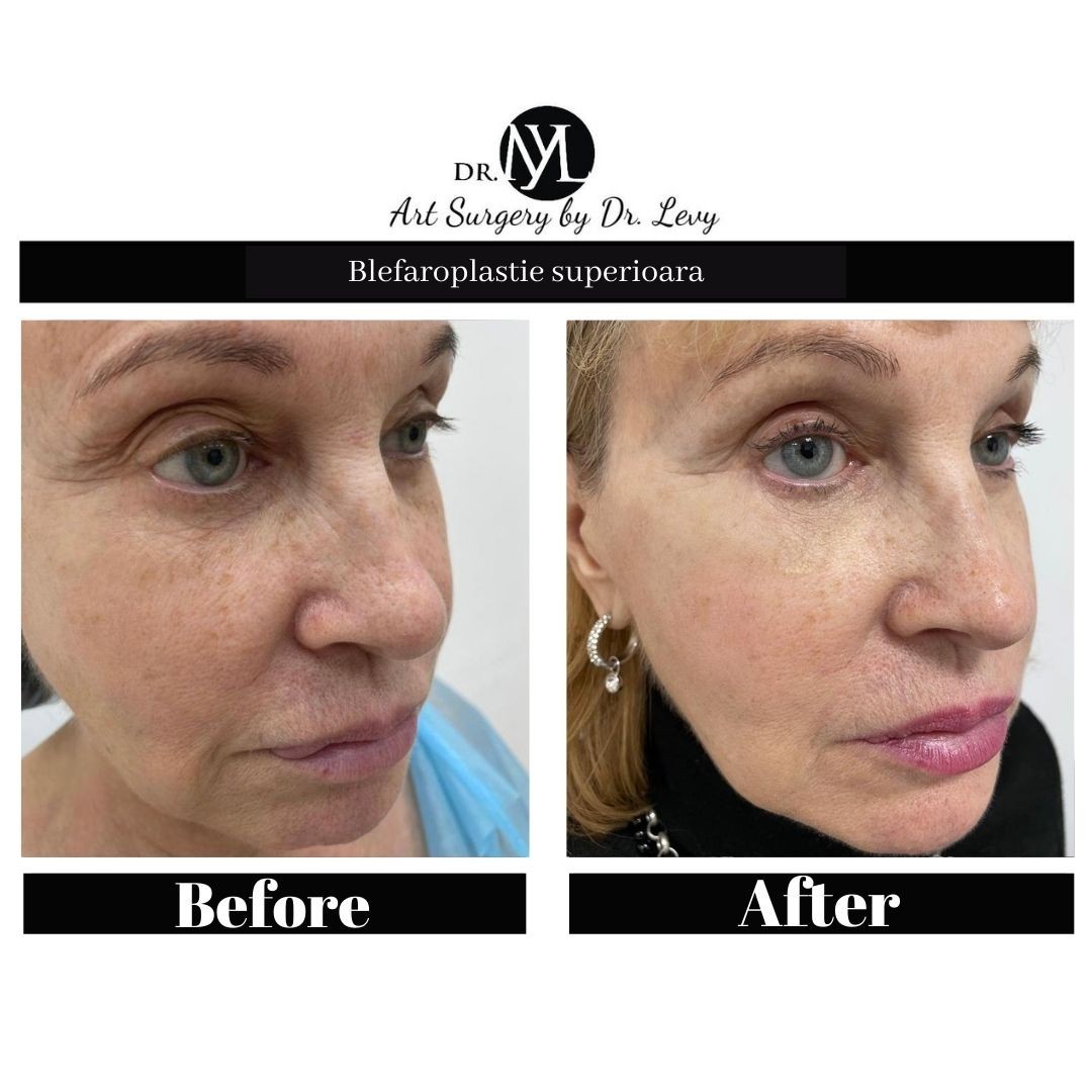 poze operatie blefaroplastie superioara