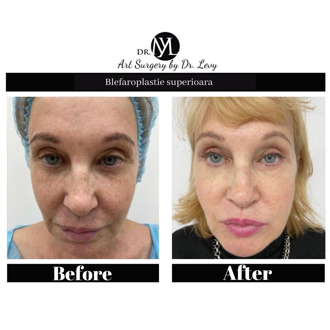 poze operatie blefaroplastie superioara